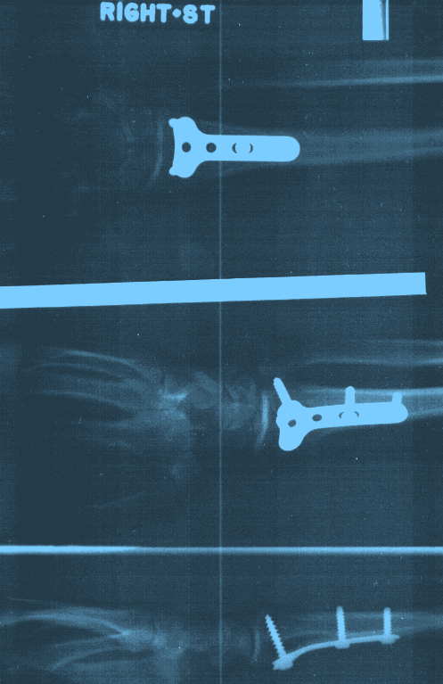 1995 X-Ray of Hill's Wrist